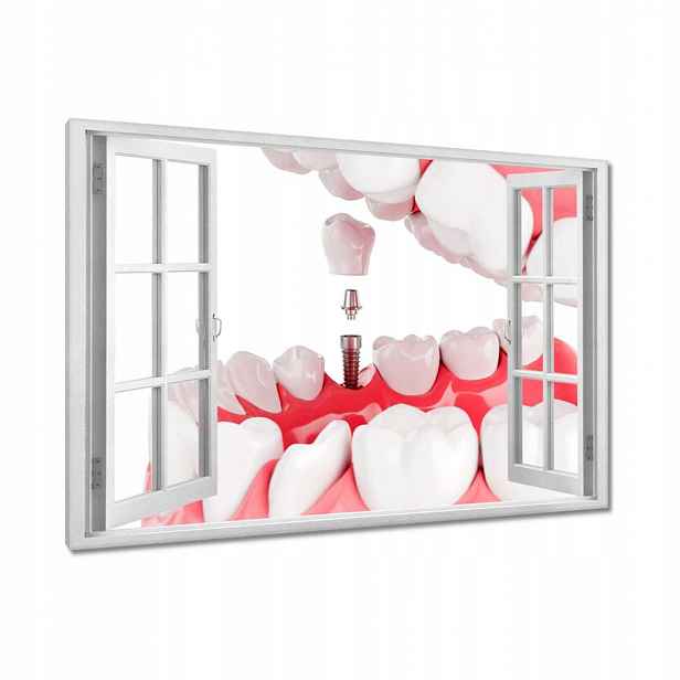 Obrazy 90x60 Zubní implantáty